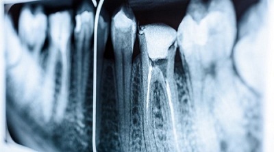 ابداع نوعی ماده پرکردنی خودترمیم که می تواند نیاز به عصب کشی دندان را از بین ببرد